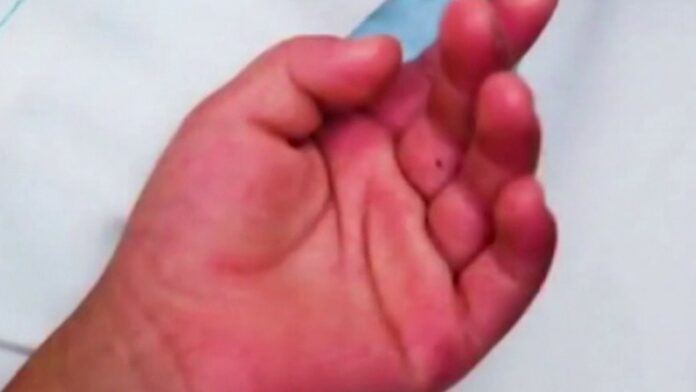 Colorado sees cases of possible coronavirus-linked mystery illness in kids: report