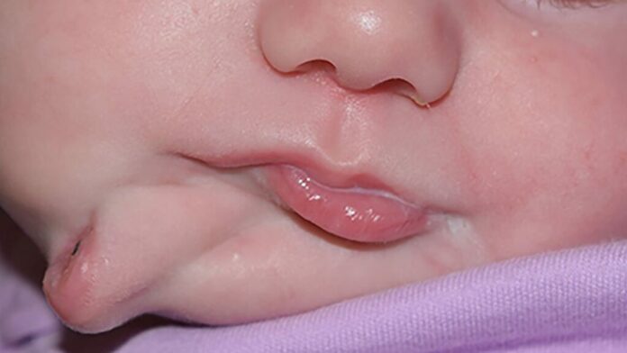 Baby girl with two mouths was born with very rare condition, doctors say