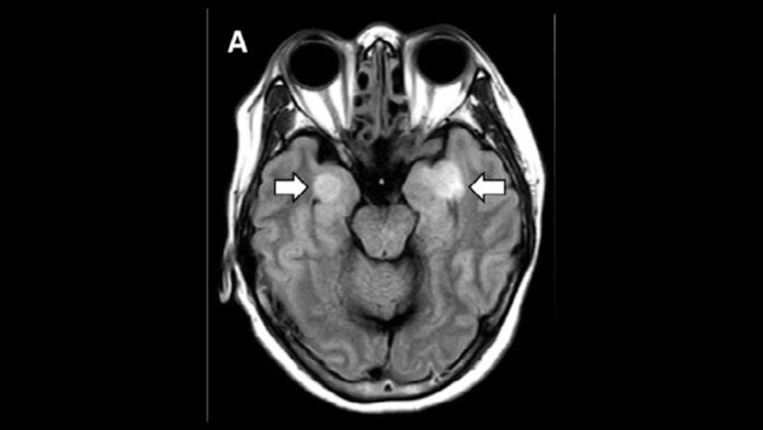 Neurologist: COVID-19 can cause memory loss, Alzheimer’s