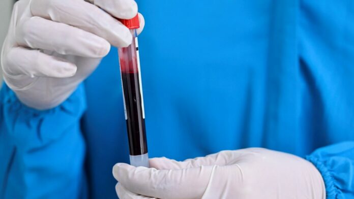 Study: Blood type may factor in COVID-19 risk, severity of symptoms
