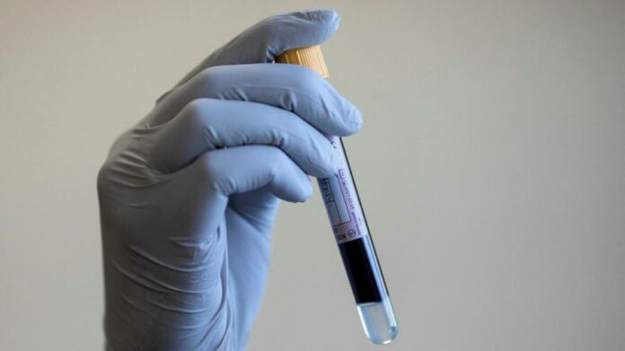 Study links blood type to lower risk of catching coronavirus