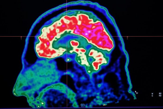 Brain problems linked to even mild virus infections: study