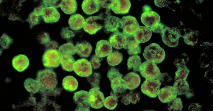 Rare case of brain-eating amoeba confirmed in Florida