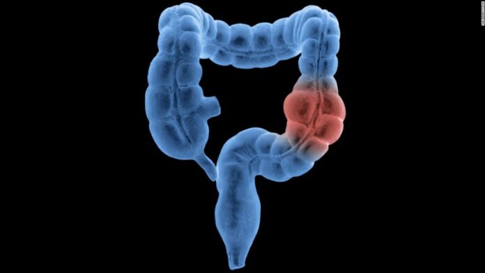 Colon and rectal cancer cases are going up among people younger than age 50, researchers say