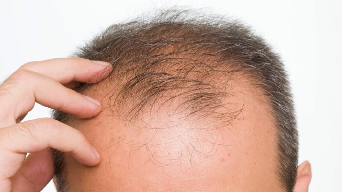 Hair loss may be a coronavirus symptom, study finds