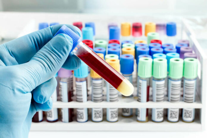 Blood test can predict psychotic disorders years before they develop