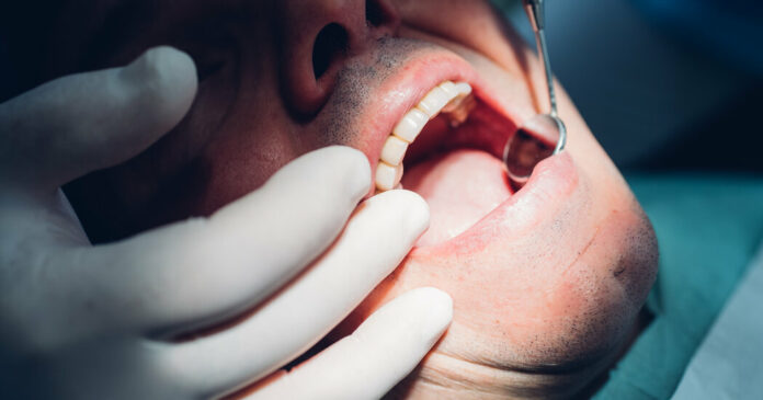 Dentists Are Seeing an Epidemic of Cracked Teeth. What’s Going On?